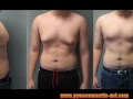 gynecomastia-adolescent-teenagers-male-breast-reduction.html