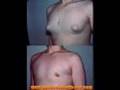 Gynecomastia Adolescent, Teenagers, Male Breast Reduction