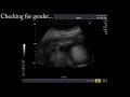 Ultrasound at 19 Weeks 3 Days