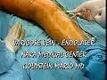 ENDOLASER