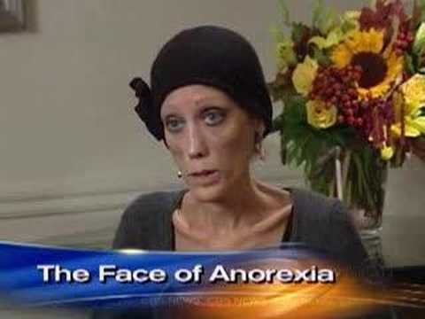 cbs news - Isabelle Caro is the face behind a poignant Italian ad campaign that depicts anorexia in its truest form, one that has shocked the fashion industry. Sheila M...