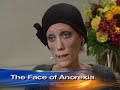 Anorexia\