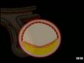 Curing Atherosclerosis - by protecting plaques