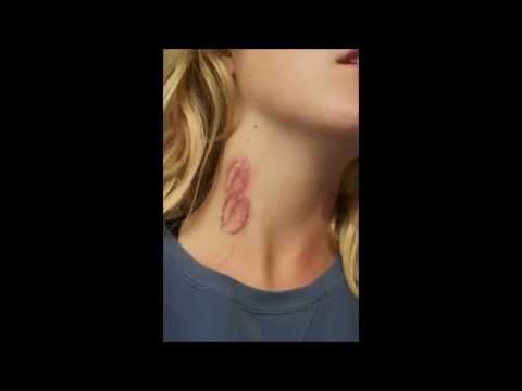 how to get rid of hickeys