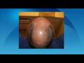 Hair Loss Treatment