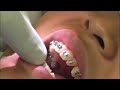finishing bends using intra oral pliers