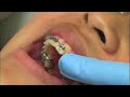 finishing bends using intra oral pliers