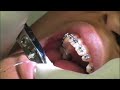 finishing bends using intra oral pliers