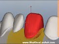 Nha Khoa Lan Anh . com - Qui trinh Toan su Cercon sieu chac