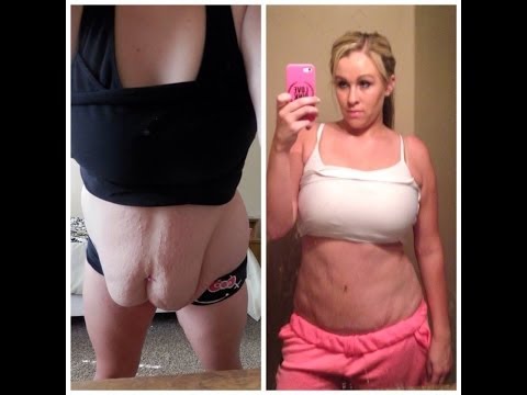 tuck - Its officially been ONE year since my tummy tuck surgery! So i made a flash back video on my journey! Hope you enjoy! And i thank you all from the bottom of ...