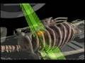 Cancer treatment with respiratory gating