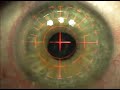 IntraLasik Surgery