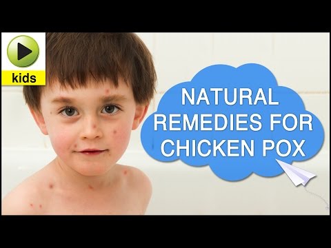 how to treat chicken pox