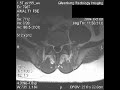 A few years ago, I had a major problem.  You know it's bad when a surgeon looks at your MRI films, looks back at you and says in a concerned voice 