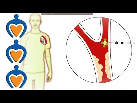 how to treat embolism