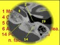 anatomia basica en el tac de peñascos axial/coronal