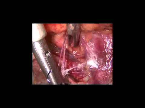 how to tell if hernia repair failed