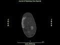 Unusual Complication of an Infiltrated Intravenous Catheter: Heterotopic Ossification in a Newborn