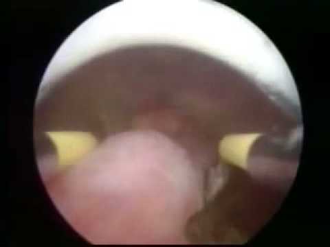 endometrio