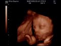 removing-a-placenta-from-a-mother-cow-in-indonesia.html