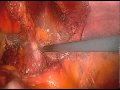 Application Of Robotically-Assisted and Laparoscopic Procedure in Pediatrics (1/2) Application Of Robotically-Assisted and Laparoscopic Procedure in Pediatrics (1/2)