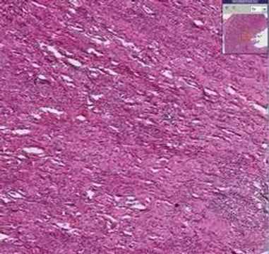 Histopathology Kidney-- Acute and ...