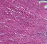 Acute and chronic pyelonephritis Acute and chronic pyelonephritis