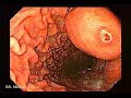Video Endoscopy of Enormous Gastric Leiomyoma