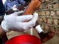 videos de Child With Swollen Foot