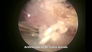Arthroscopic decompression for calcific tendinosis