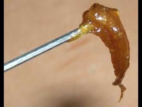 how to dissolve ear wax with hydrogen peroxide