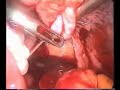 laparoscopic myomectomy