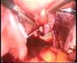 laparoscopic myomectomy