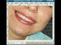 Smooth skin with healing brush in GIMP 2.4 Smooth skin with healing brush in GIMP 2.4