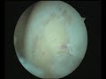 ???????????? DEBRIDEMENT ??????? ???????????? DEBRIDEMENT ???????