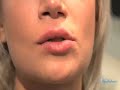 Day Spa Restylane and Collagen Filler, Chicago | SpaTube.Tv - 1
