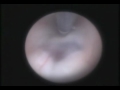 ENDOSCOPIC THIRD VENTRICULOSTOMY VIDEO.mpg
