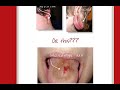 Getting a Body Piercing