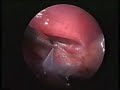 CIRUGIA DE HERNIA DIFRAGMATICA CIRUGIA DE HERNIA DIFRAGMATICA