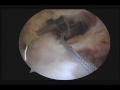 Arthroscopic Correction Of Rotator Cuff Due To Partial Rupture Arthroscopic Correction Of Rotator Cuff Due To Partial Rupture
