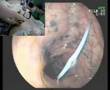 Percutaneous Endoscopic Colostomy (PEC)