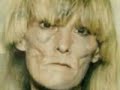 Face of addiction - The effects of crystal meth