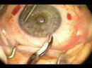 IntraLase  Enabled Keratoplasy (IEK)