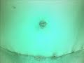Tummy Tuck - My Before and After Pics of Abdominoplasty - Excess Skin Removed - Surgery Scars Tummy Tuck - My Before and After Pics of Abdominoplasty - Excess Skin Removed - Surgery Scars
