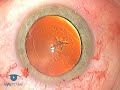 Hydrodissection Complications Phaco 3.2 Complications Hydrodissection Complications Phaco 3.2 Complications