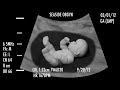 Download SNOOKI'S SONOGRAM!!! MP3 song and Music Video