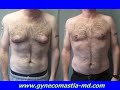 gynecomastia-adolescent-teenagers-male-breast-reduction.html
