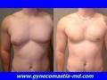 Gynecomastia Severe Male Breast Reduction
