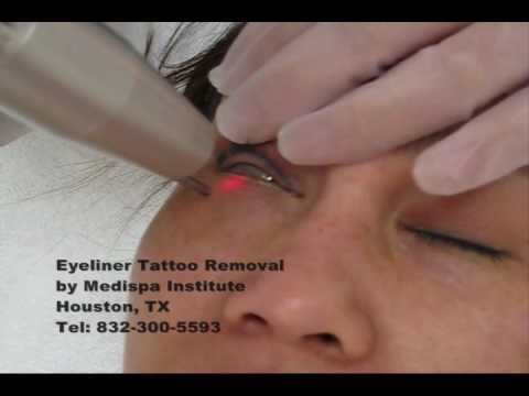 Laser Tattoo Removal - Eyeliner Tattoo. www.medispainstitute.com Tel: 