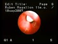 LARYNGOSCOPY